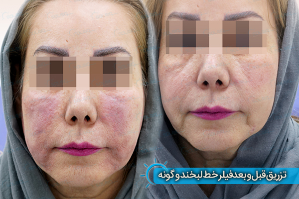 تزریق فیلر گونه و خط لبخند در کلینیک زیبایی سولا