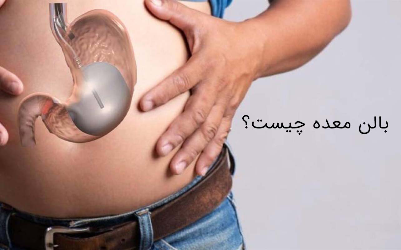 بالن معده چیست؟