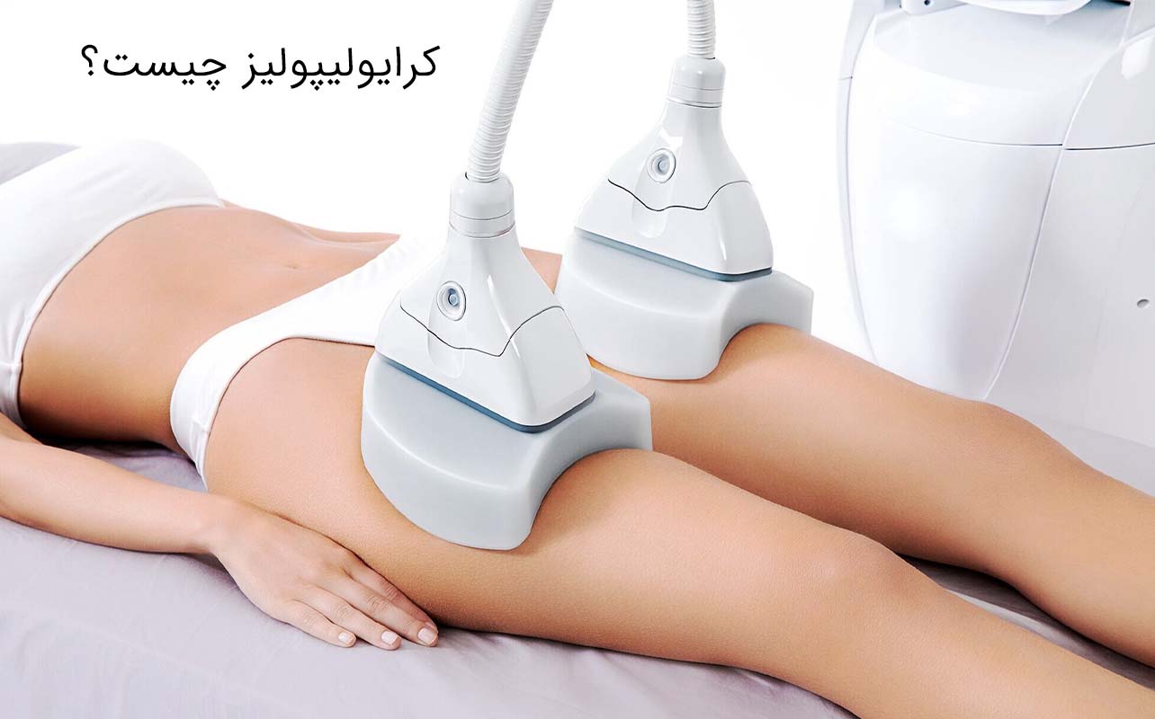کرایولیپولیز