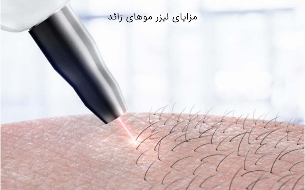 مزایای لیزر موهای زائد