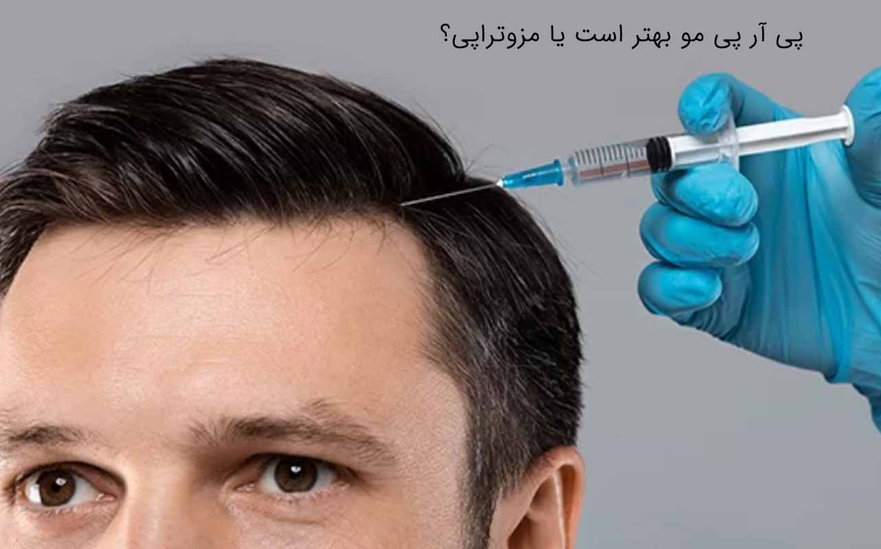 پی آر پی مو بهتر است یا مزوتراپی؟