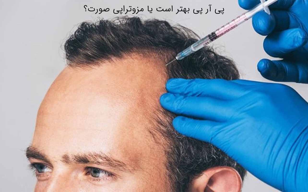 عوارض پی آر پی مو