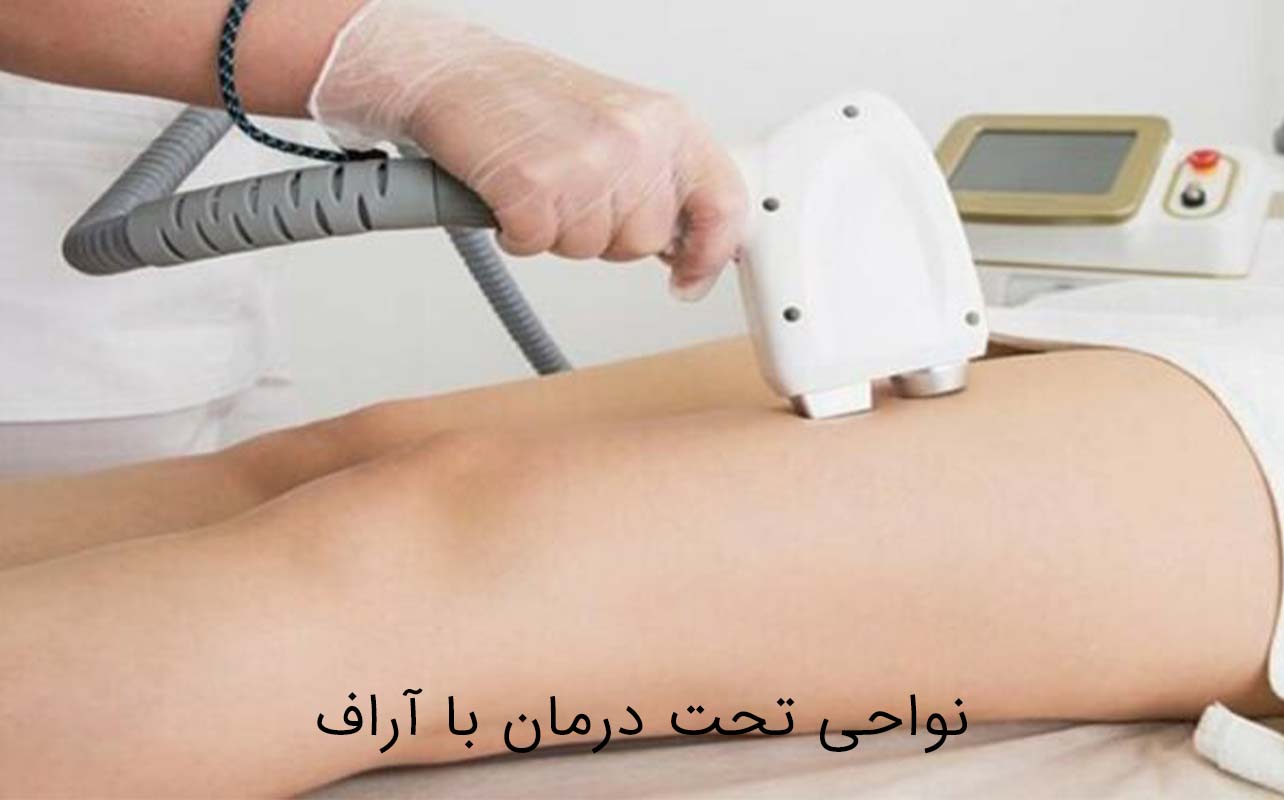 لاغری بدون جراحی با آر اف