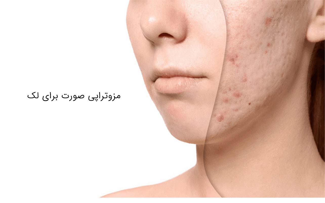 مزوتراپی صورت برای لک