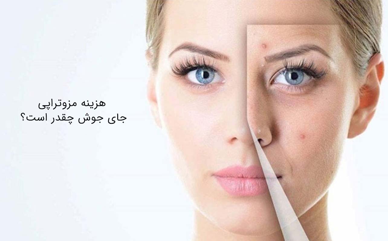 هزینه مزوتراپی جای جوش