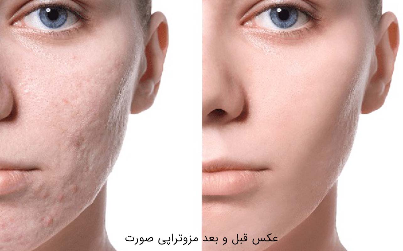 عکس قبل و بعد مزوتراپی صورت