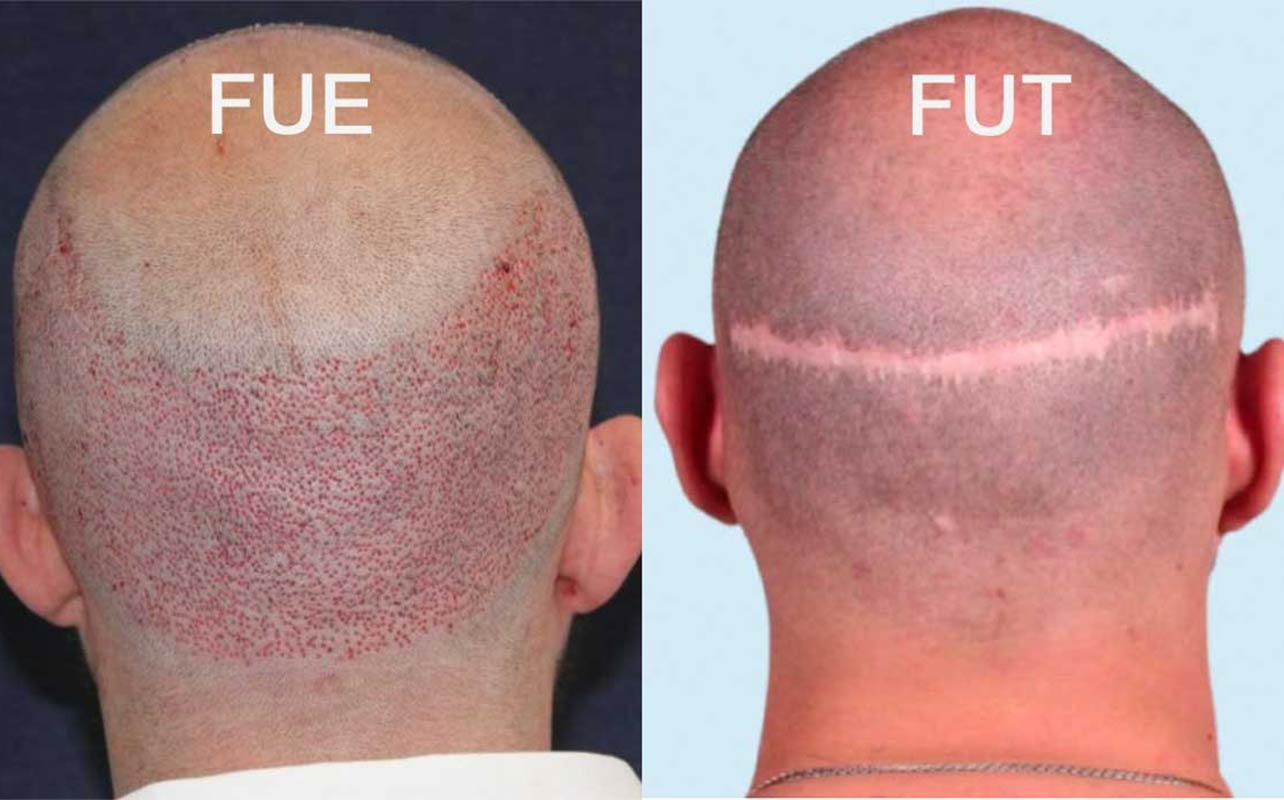کاشت مو به روش FUT