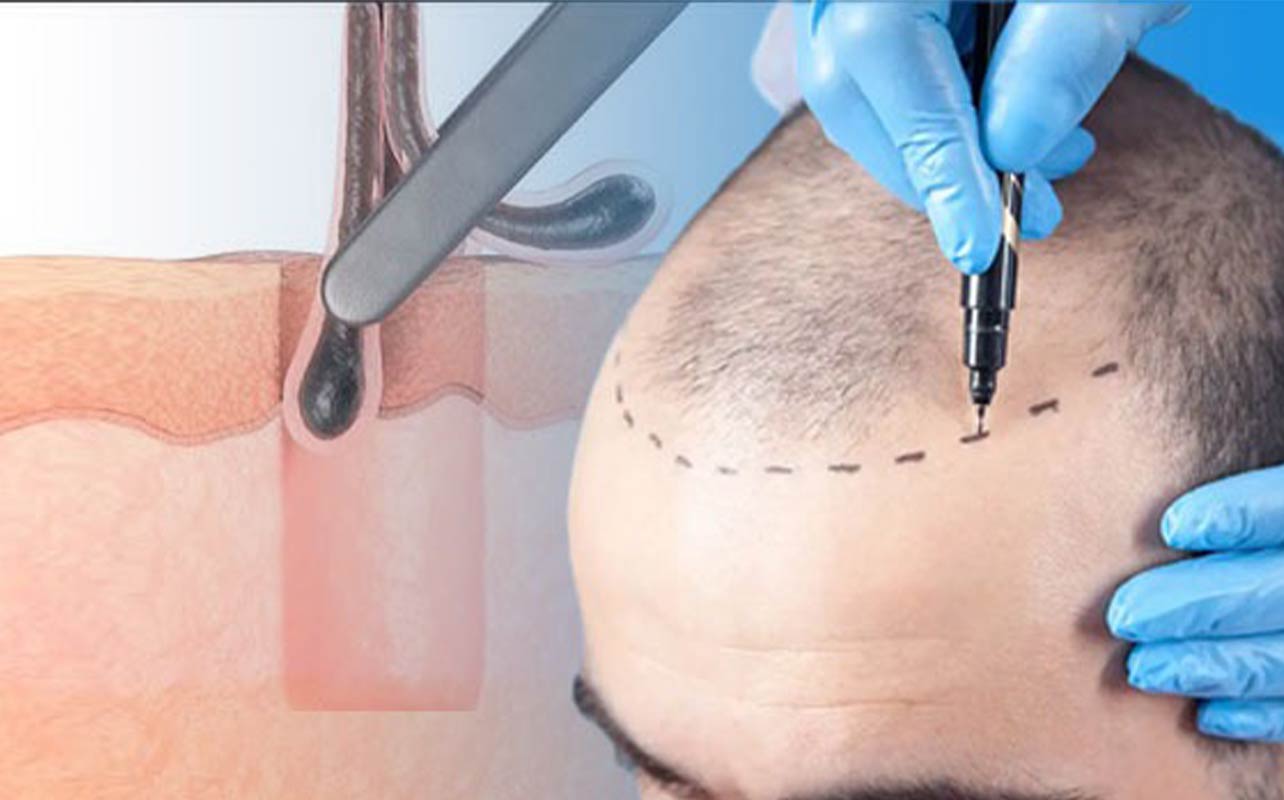 کاشت مو به روش SUT