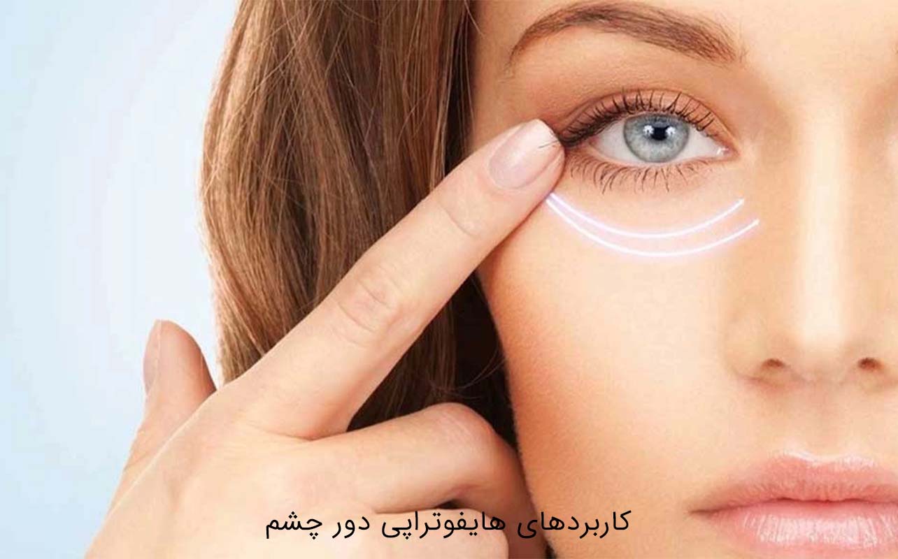 هایفوتراپی دور چشم