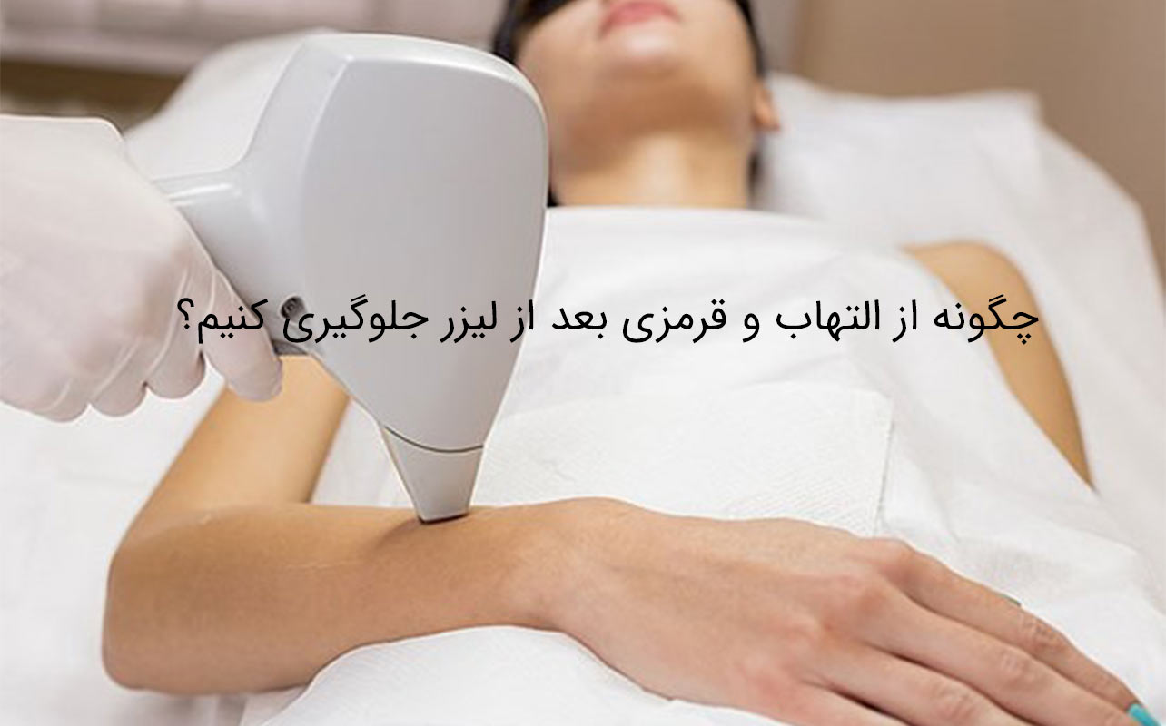 مراقبت بعد از لیزر