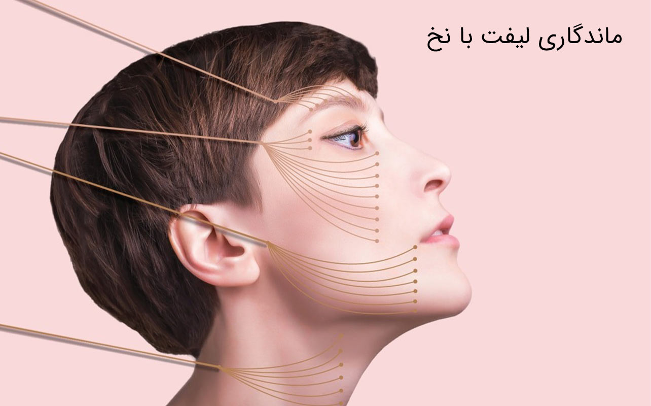 ماندگاری لیفت با نخ