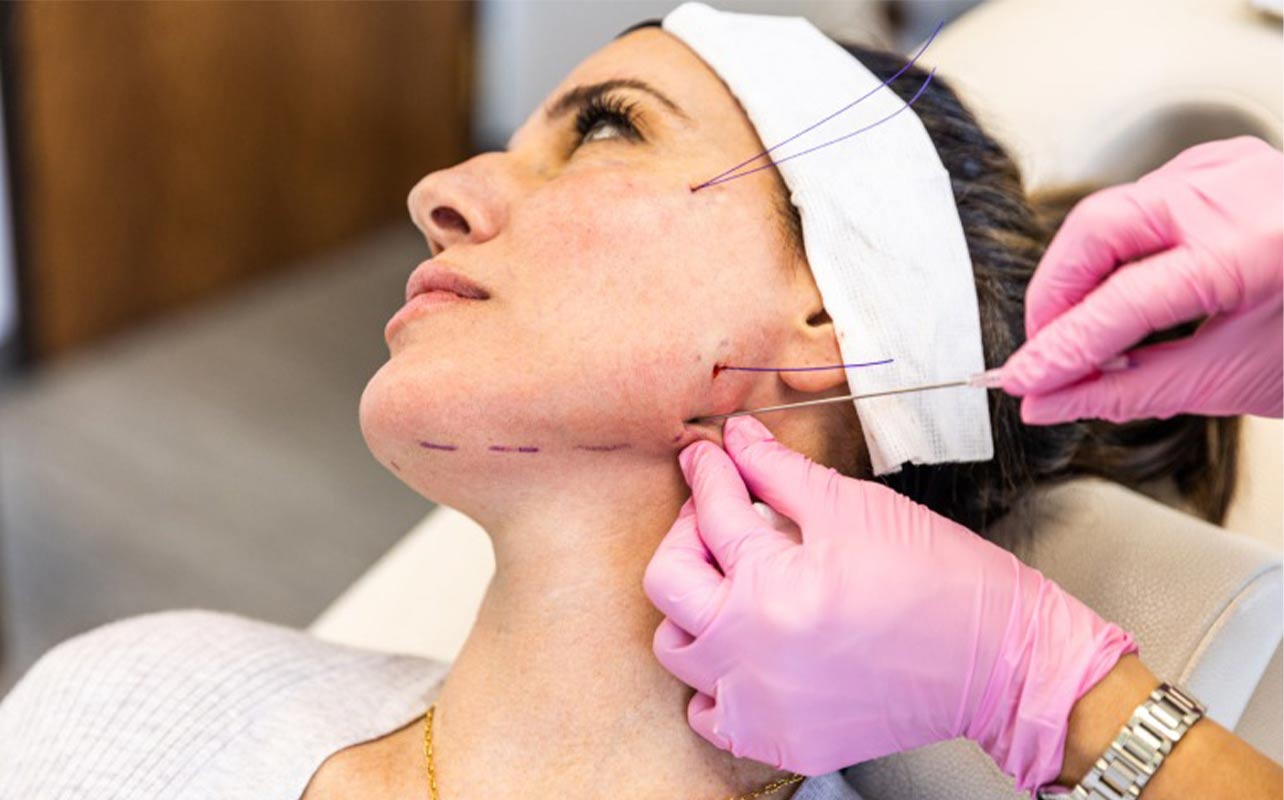 نخ‌ های لیفت