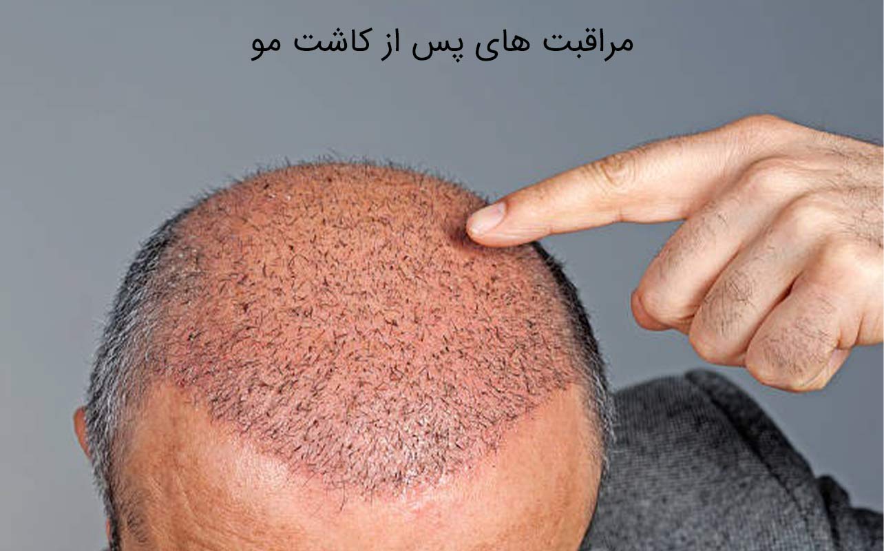 مراقبت‌ های پس از کاشت مو