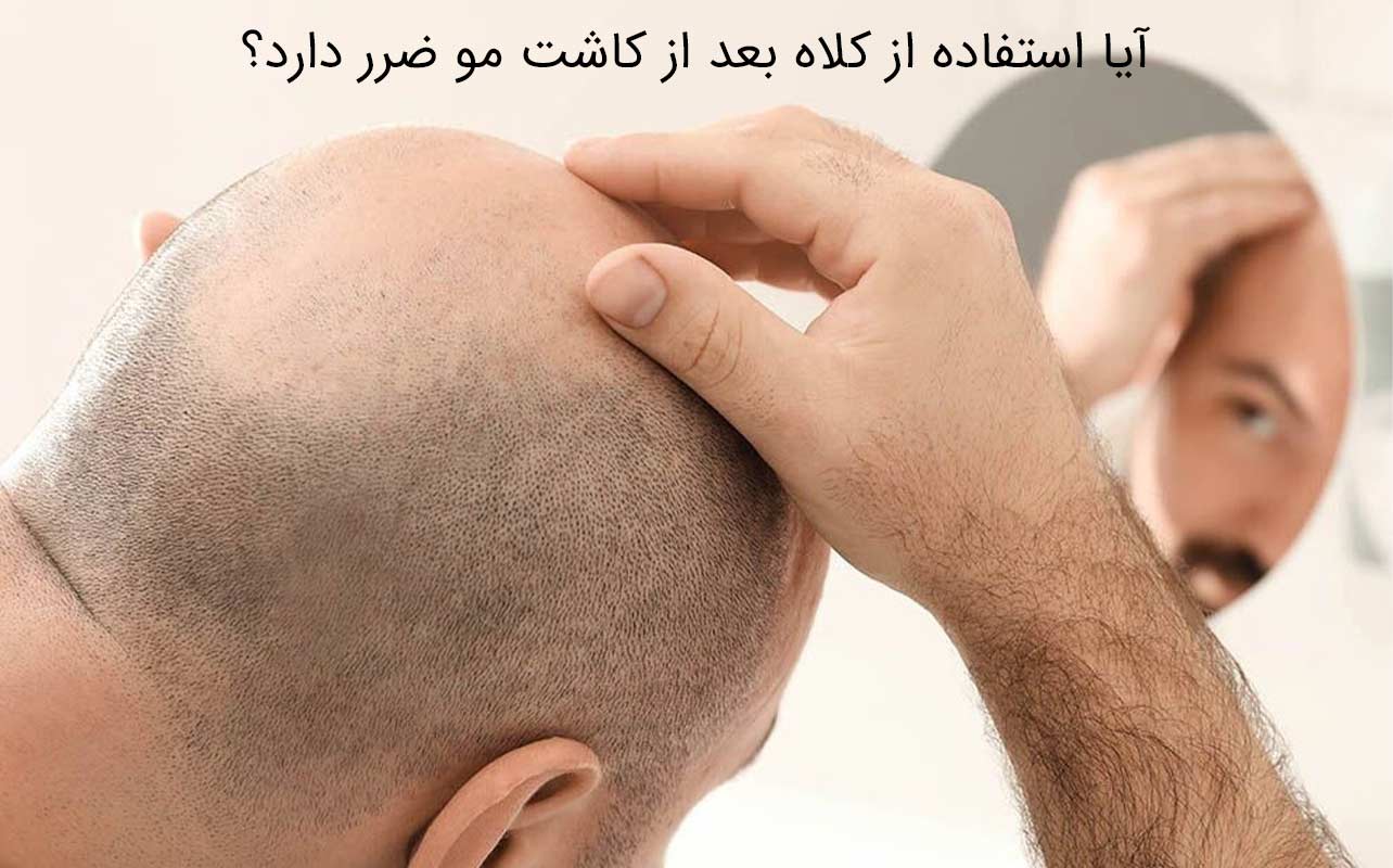 کاشت مو