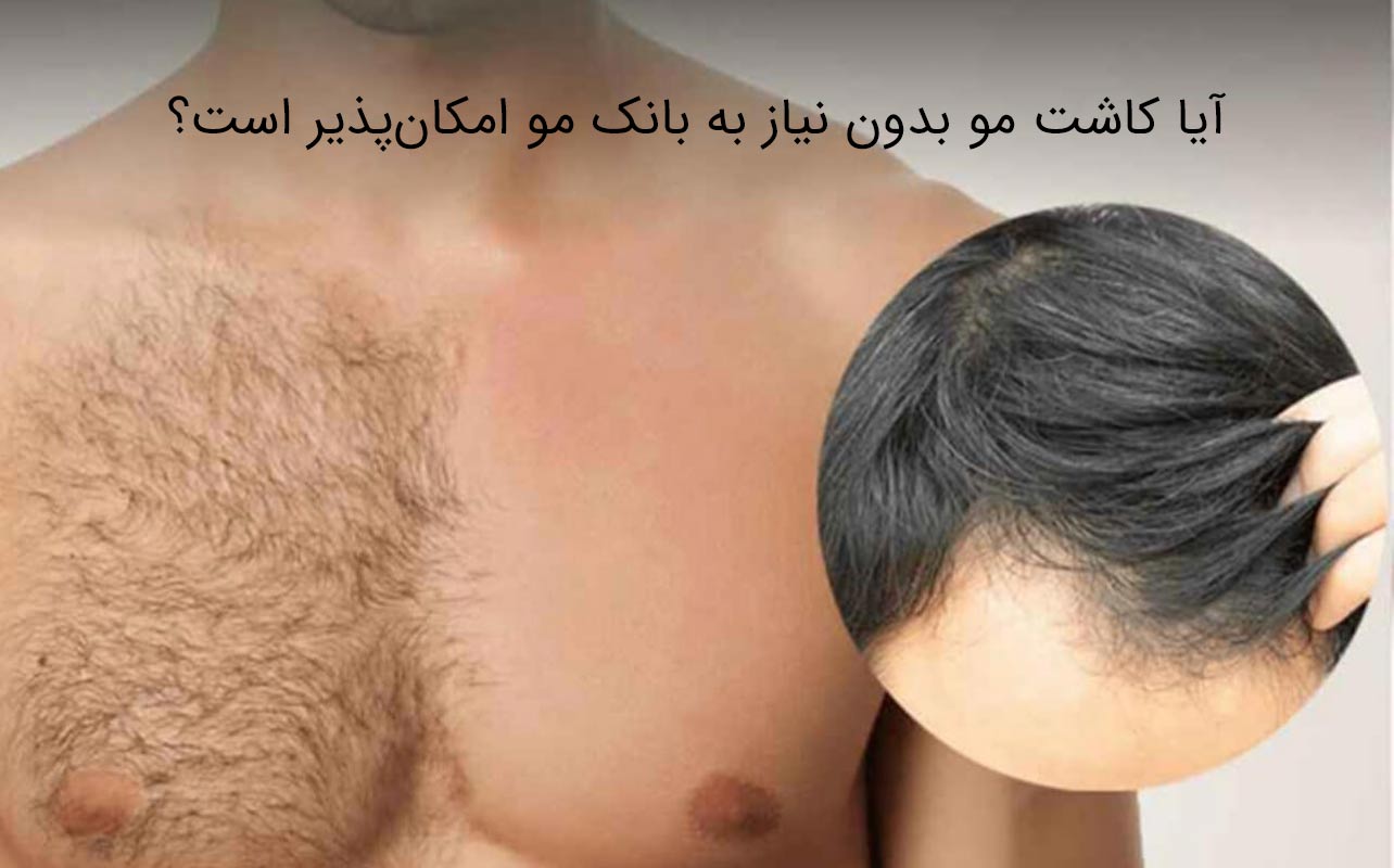 اهمیت بانک مو در کاشت مو