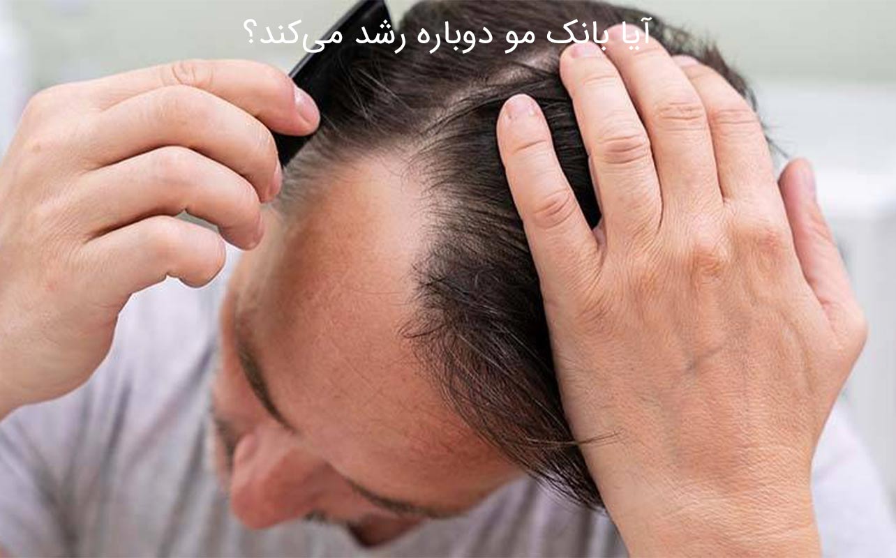 ریزش بانک مو