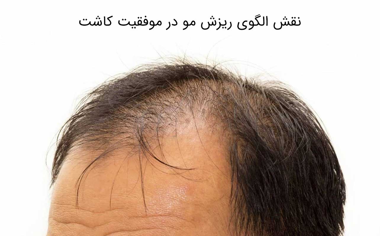 الگوی ریزش مو