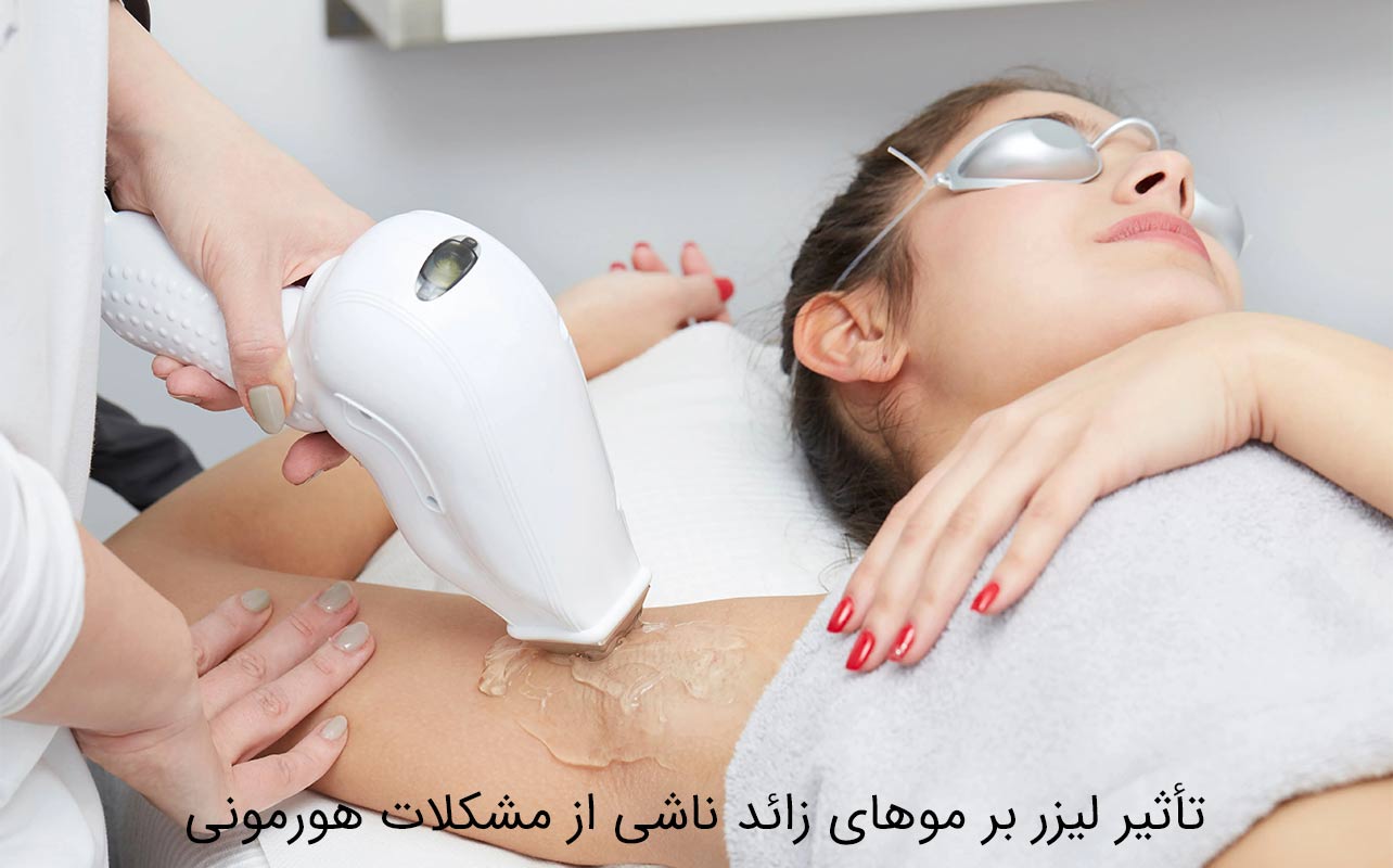 لیزر موهای زائد