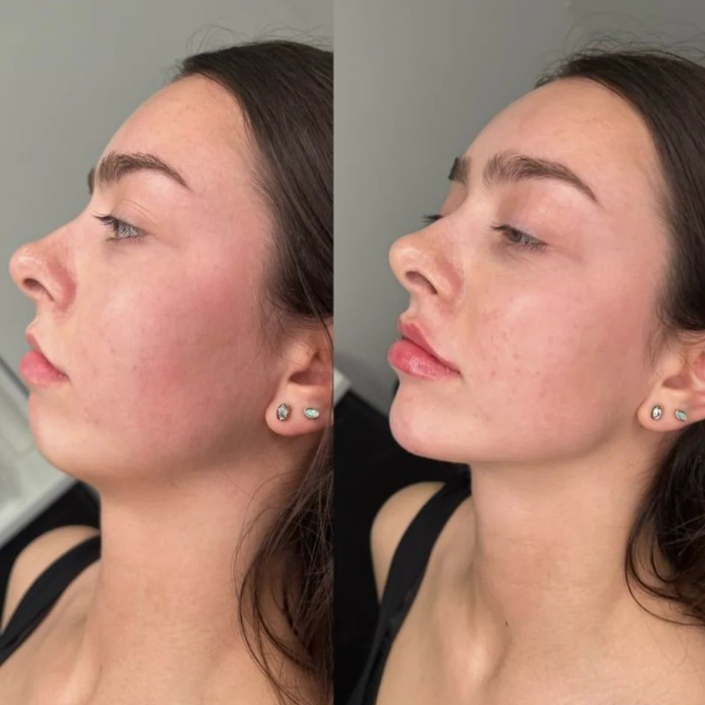 عکس‌ قبل و بعد فیلر چانه