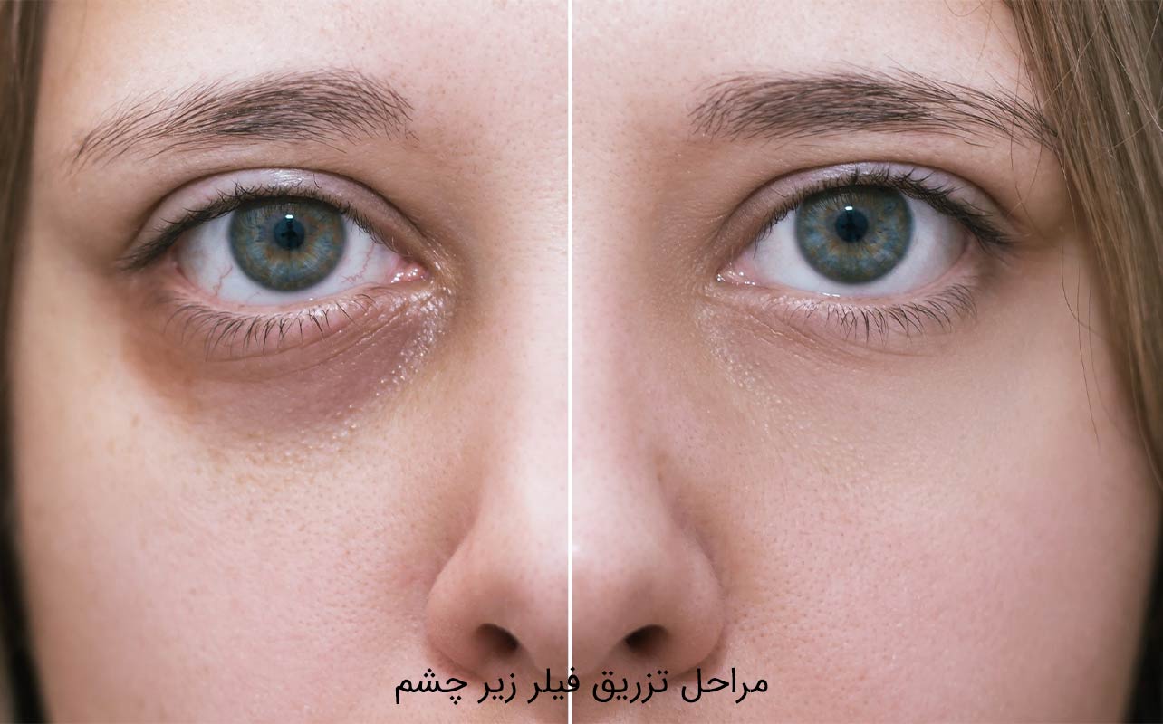 فیلر زیر چشم