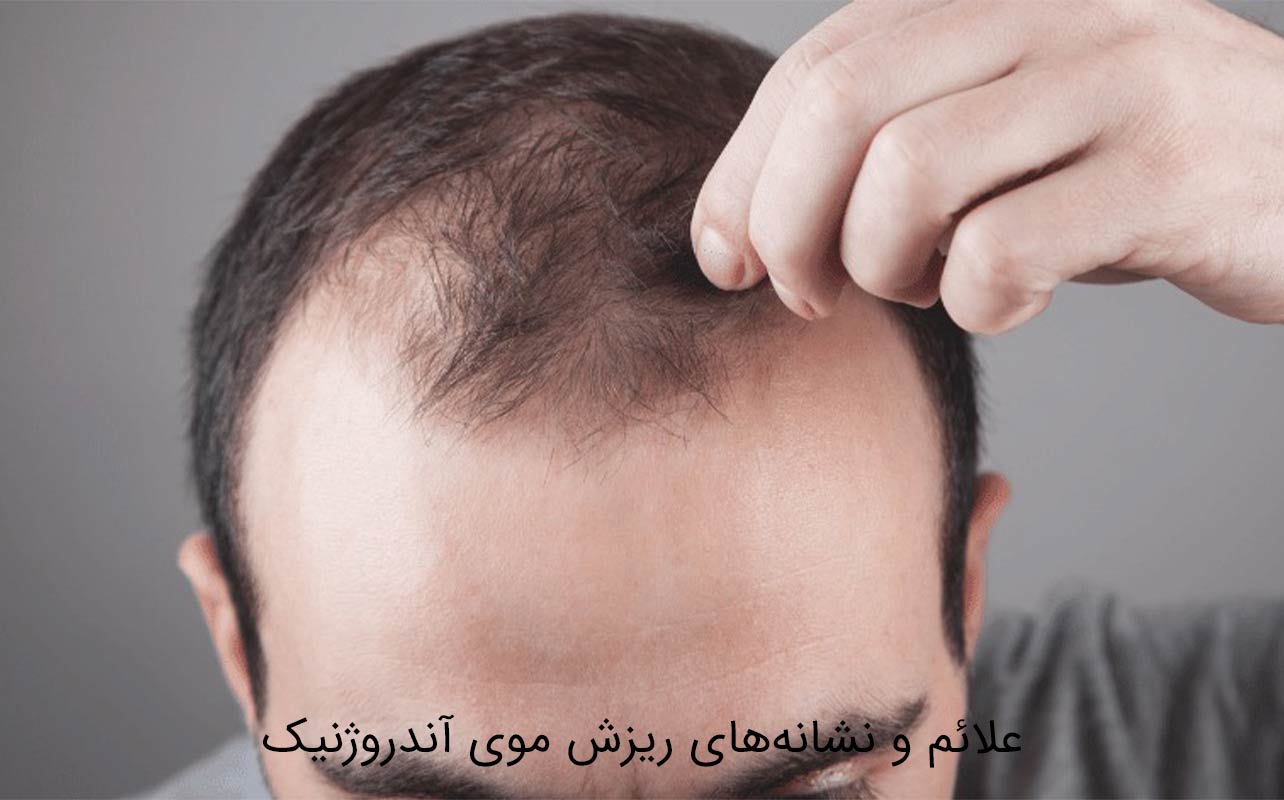 ریزش موی آندروژنیک