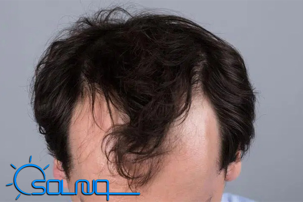 ریزش موی آندروژنیک چیست