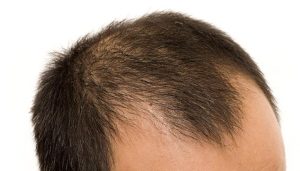 اسکالپ موی سر برای چه کسانی مناسب است ؟